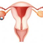 Diagram of a uterus with ovaries in which one has ovarian cancer.