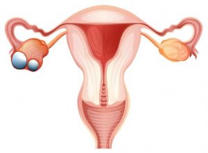 Diagramm einer Gebärmutter mit Eierstöcken, bei welchem einer mit einem Ovarialkarzinom befallen ist.